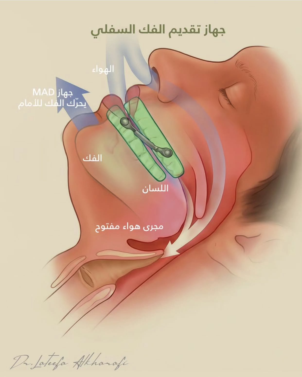 جهاز تقديم الفك السفلي لعلاج انقطاع التنفس — د. لطيفة الخرافي